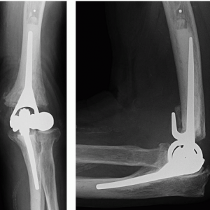 Open arthroplastie elleboog