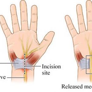 Carpaal tunnel release