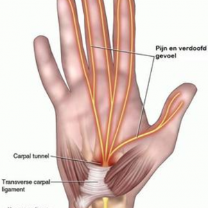 Carpaal tunnel syndroom