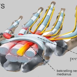 Carpaal tunnel syndroom