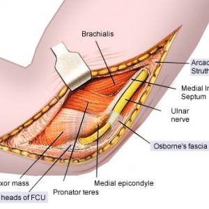 Cubitaal tunnel syndroom