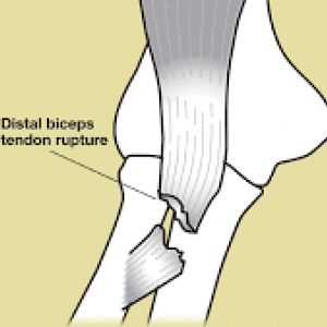 Distale bicepspeesruptuur - Symptomen & diagnose