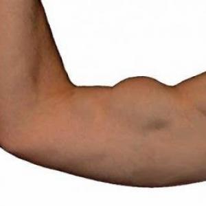 Distale bicepspeesruptuur - Symptomen & diagnose