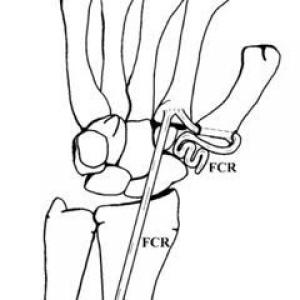 Trapezectomie met gebruik van eigen peesweefsel voor ligament-reconstructie en interpositie