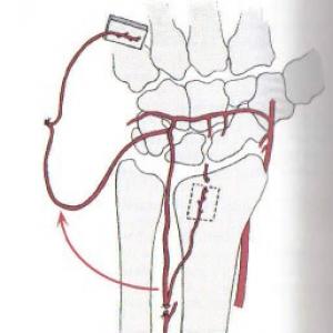 Radius verkortings osteotomie