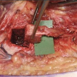 Radius verkortings osteotomie