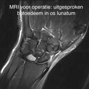 Radius verkortings osteotomie