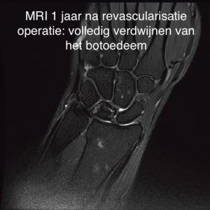 Radius verkortings osteotomie