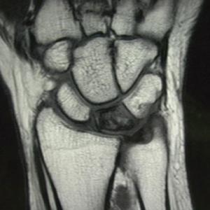 Radius verkortings osteotomie