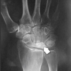 Radius verkortings osteotomie