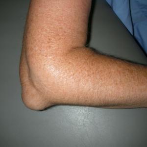 Bursitis olecrani - Symptomen & diagnose