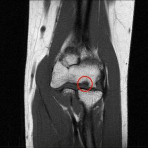 Osteochondritis dissecans - Symptomen & diagnose