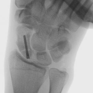 Scafoidfractuur