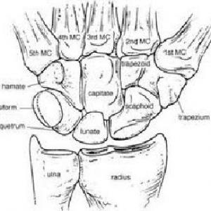 Scafoidfractuur