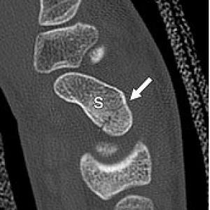 Scafoidfractuur