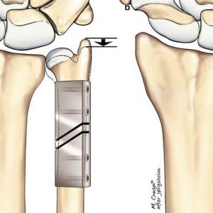 Ulna verkortings osteotomie