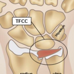 TFCC scheur