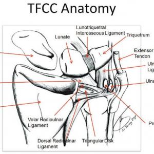 TFCC scheur