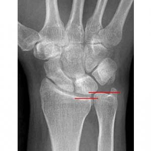 Ulnocarpaal impingement