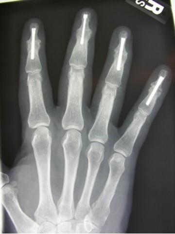 Îndepărtați rapid inflamația din articulație, Cum să înțelegeți că aveți artrită degetului mare?
