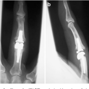 nutriție și tratament pentru artroza genunchiului infecții ale inflamațiilor articulare