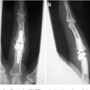 inflamația dimexidului articulației ligamentelor)