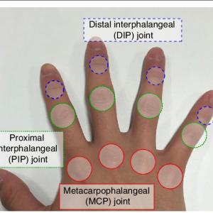 MCP prothese